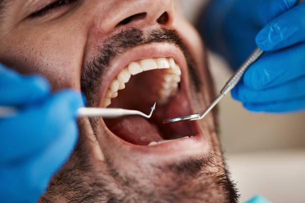 Best Root Canal Emergency Dentist  in Mccom, OH